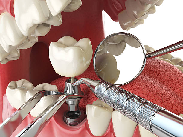 Best Chipped Tooth Repair Near Me  in Wooster, OH